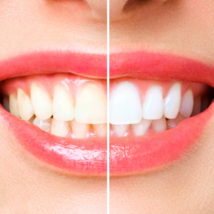 Elite Dental - Waxhaw - Arboretum - Teeth Whitening