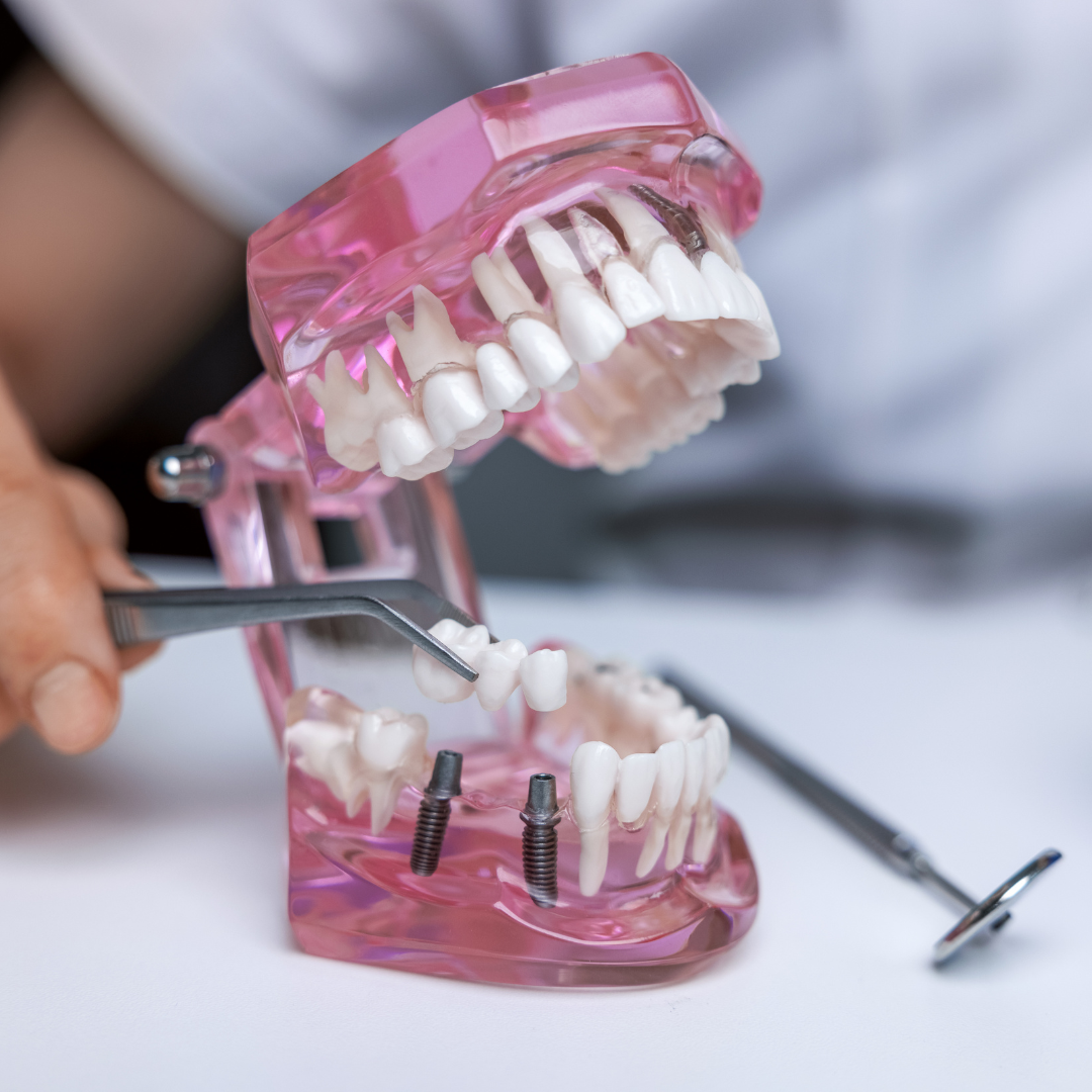 Dental Bridges Restoring Your Smile and Dental Function